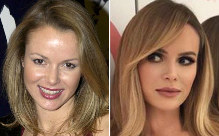 Amanda Holden Plastic Surgery - She Looks Better Now Than She Did in Her Twenties!